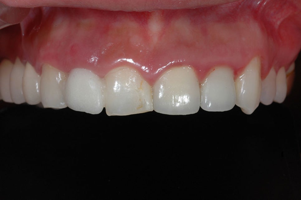 논현동라미네이트 인상이 좋아 보이도록 관련 이미지 5