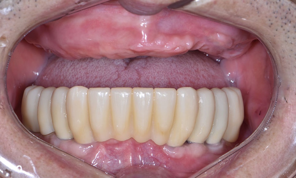 역삼동임플란트추천 치아를 건강하게 관련 이미지 4