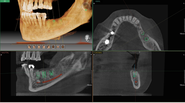 서초임플란트 경험과 디지털로 명확하게 관련 이미지 7