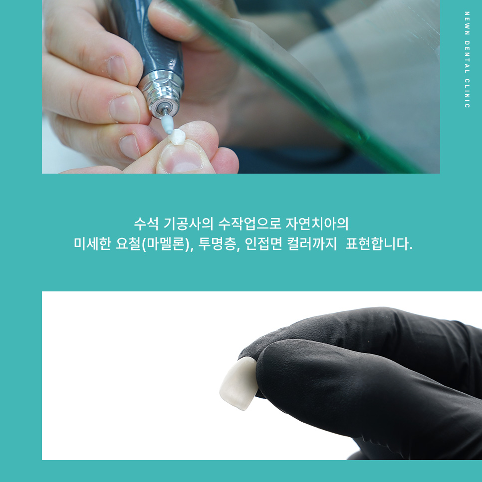 퍼스널라미 네츄럴ㅣ자연스러운 미소를 찾아주는 앞니성형, 무삭제 라미네이트 관련 이미지 8