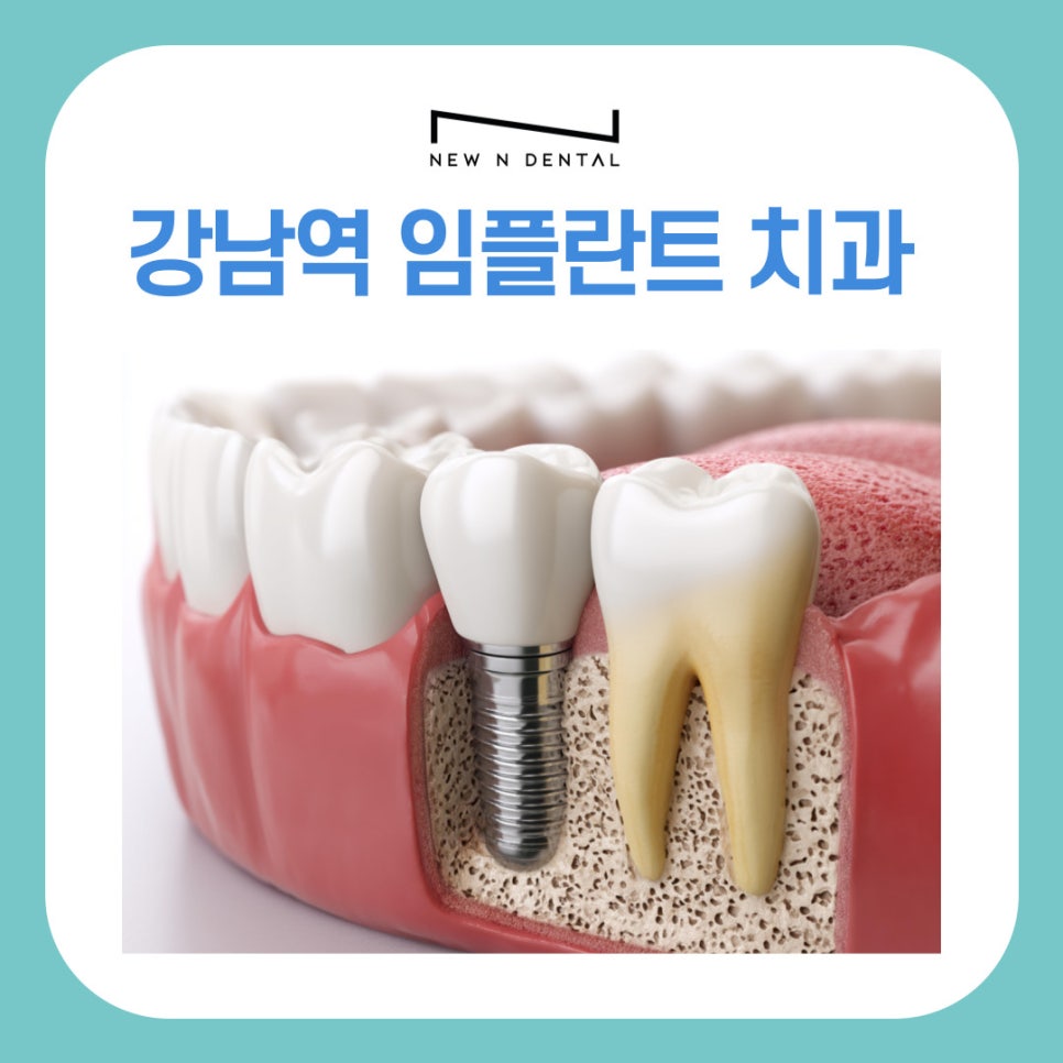 강남역치과 임플란트 시행하는 원인과 고려할 사항 관련 이미지 2