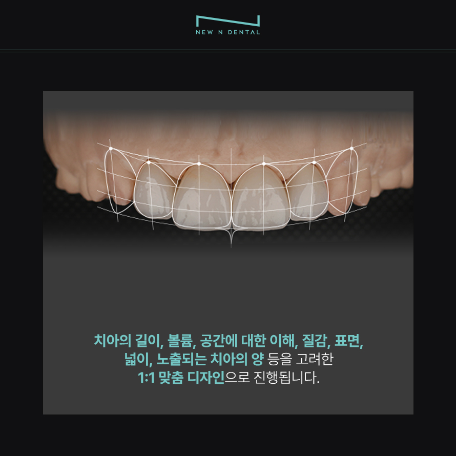 강남 무삭제 라미네이트 뉴엔치과에서 완성하는 아름다운 미소 관련 이미지 3