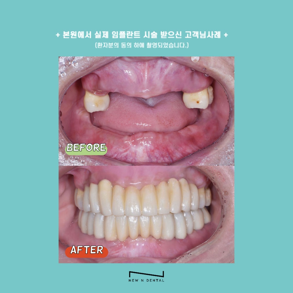 강남역 디지털임플란트 맞춤화된 진료 관련 이미지 4