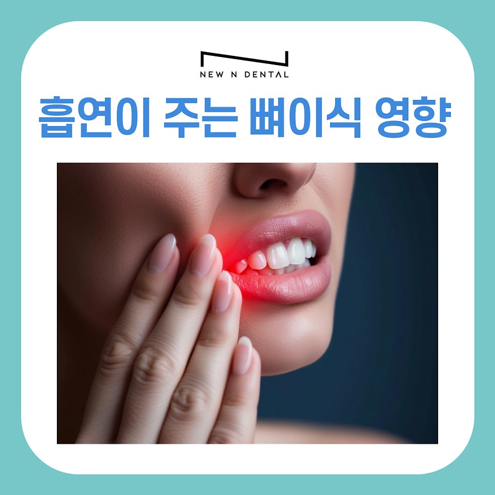 강남역치과 임플란트 뼈이식, 흡연과 음주가 미치는 영향은? 관련 이미지 4