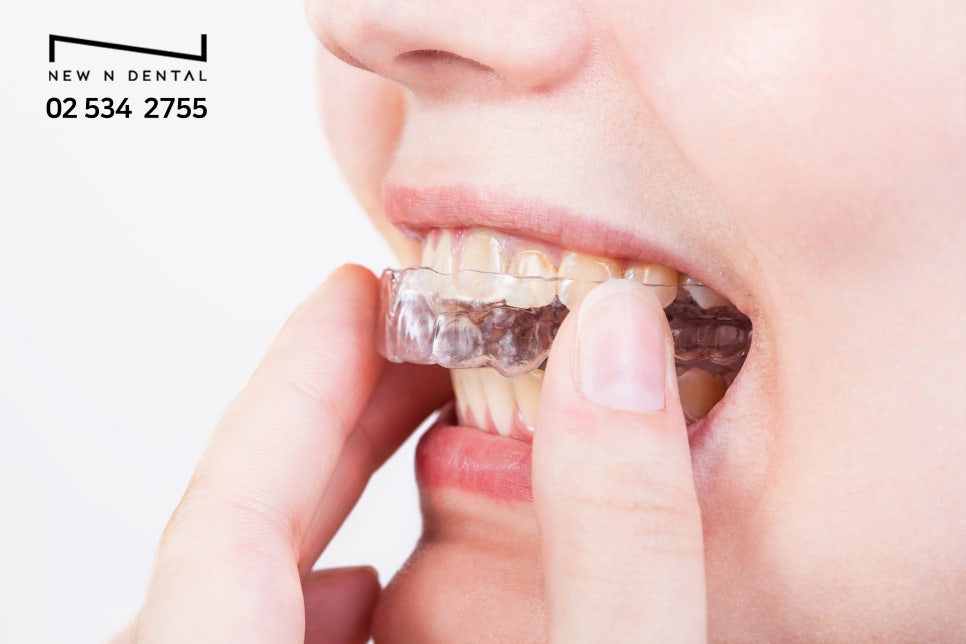 앞니벌어짐교정 나에게 맞는 방법 선택 관련 이미지 6