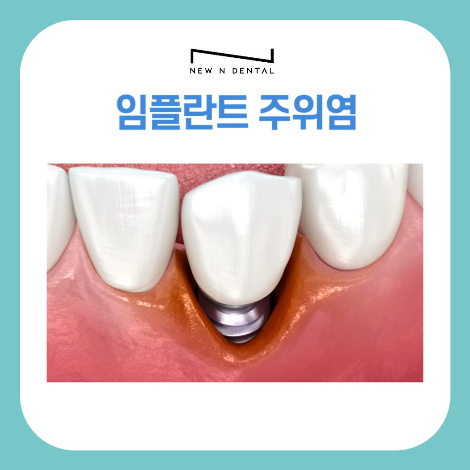 Gangnam Peri-Implantitis: Causes, Symptoms, and Prevention image 1