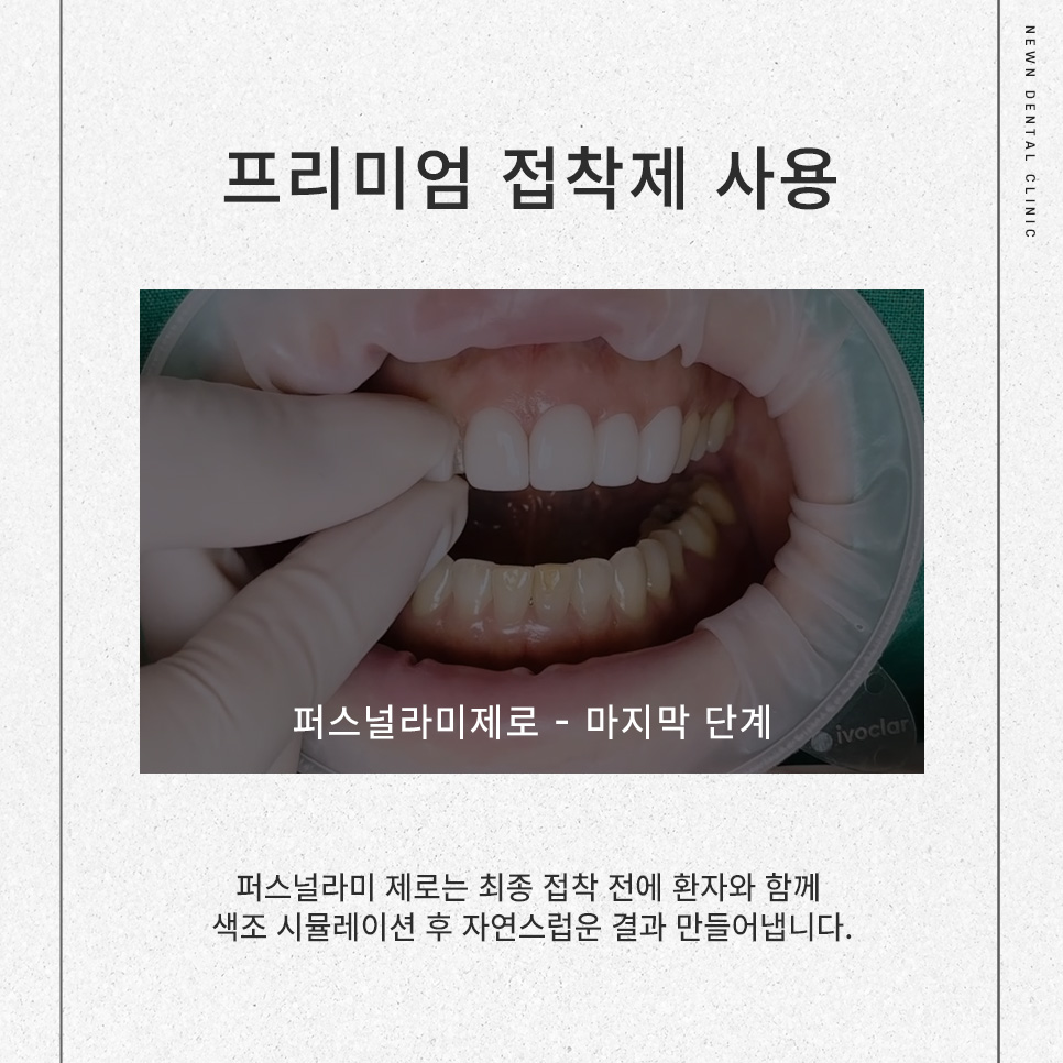 [뉴엔치과] 강남 무삭제 라미네이트, 퍼스널라미 제로 관련 이미지 5