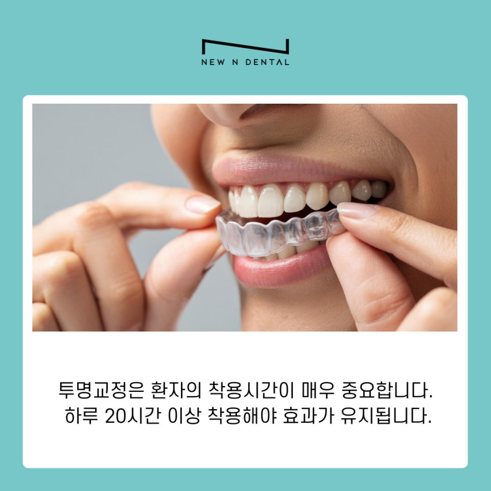 Orthodontics Near Gangnam Station: Differences Between Anterior Lingual Braces and Clear Aligners by Type image 7