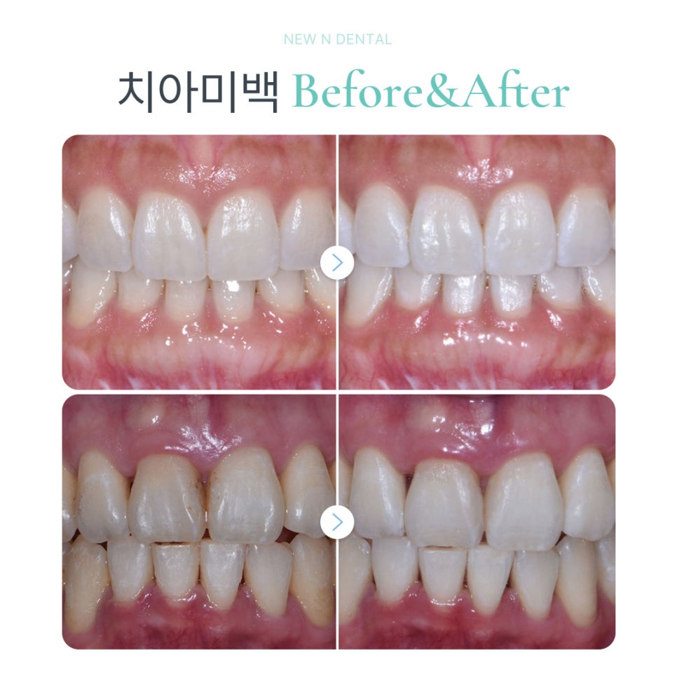 강남역미백치과가 전하는 치아미백의 모든 것 관련 이미지 8
