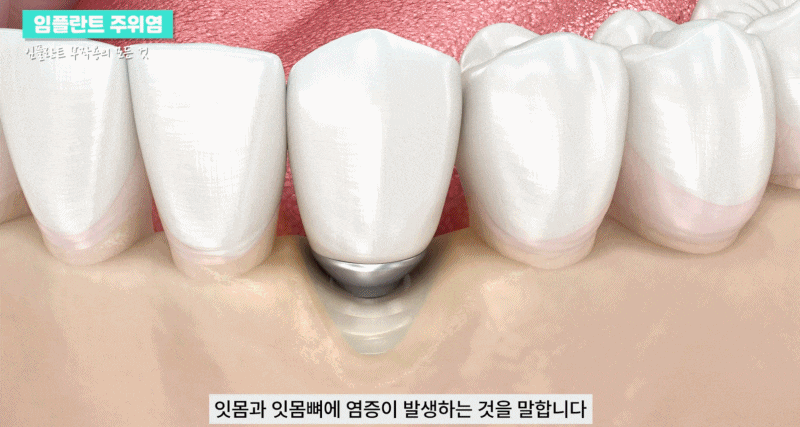 논현역치과 임플란트주위염 알아보기 관련 이미지 2