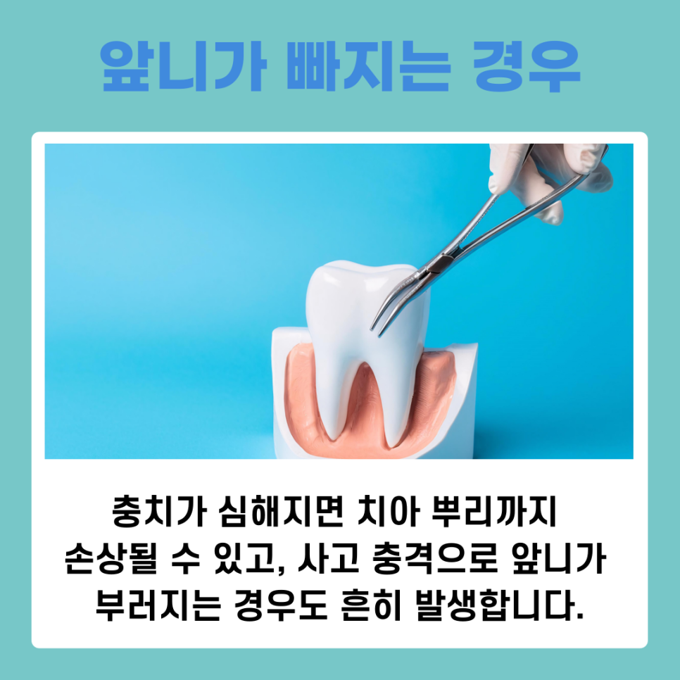 앞니 임플란트 식립 주의해야 할 사항은? 관련 이미지 3