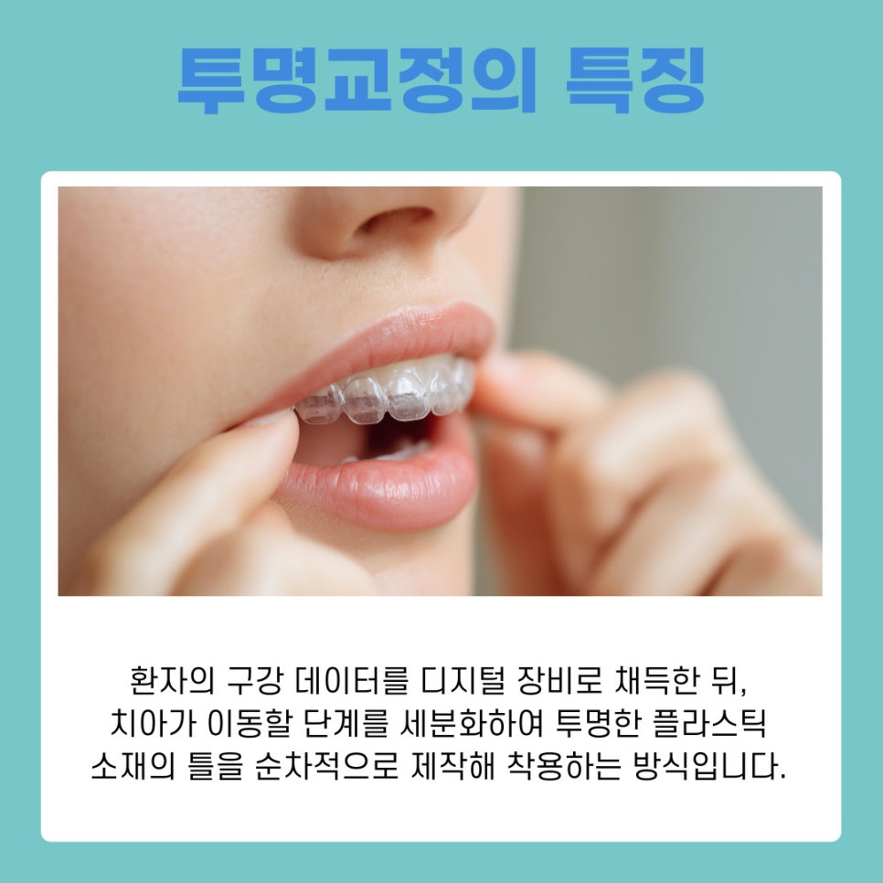 From the Features of Clear Aligners in Gangnam to How to Care for the Appliances image 6