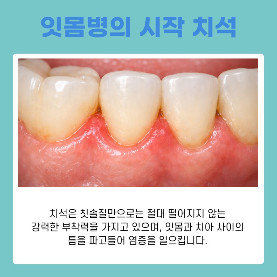 치아 건강의 핵심 서초역치과 연 1회 스케일링으로 치주염 예방 관련 이미지 4