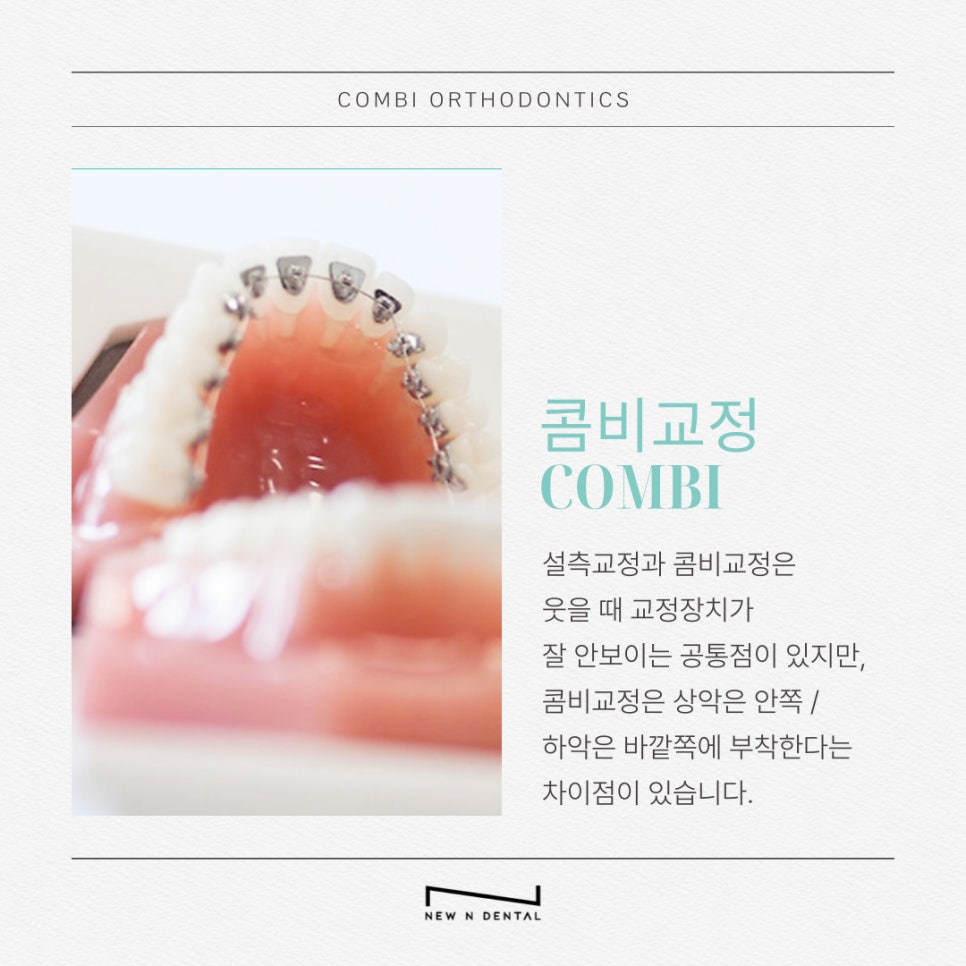 강남역치아교정치과 여러 가지 방법과 장점은? 관련 이미지 8