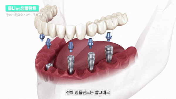 강남역임플란트 치아교정과 함께 치료 관련 이미지 7