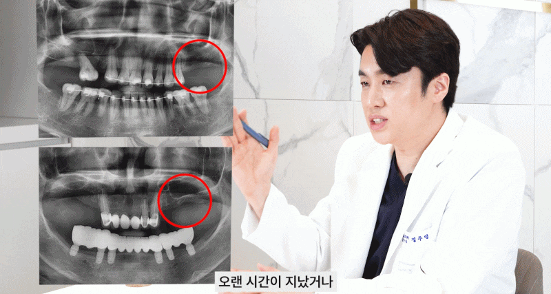 논현역치과 상악동거상술 어떤 치료일까 관련 이미지 4