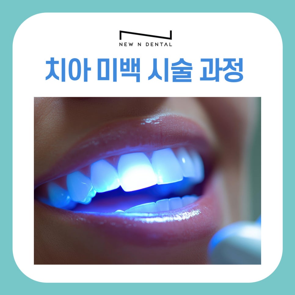강남 신사동 치과에서 알려드리는 치아 미백 시술 과정 관련 이미지 2
