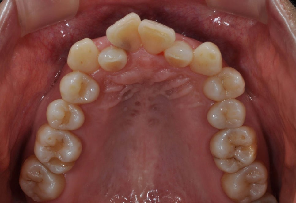 역삼동치아교정 똑똑하게 받기 위해 관련 이미지 4