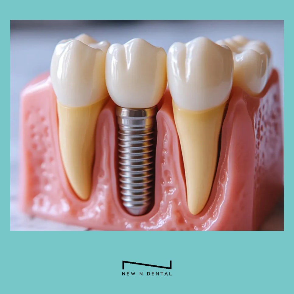 강남 당일임플란트 가능한 곳 뉴엔치과에서 관련 이미지 11