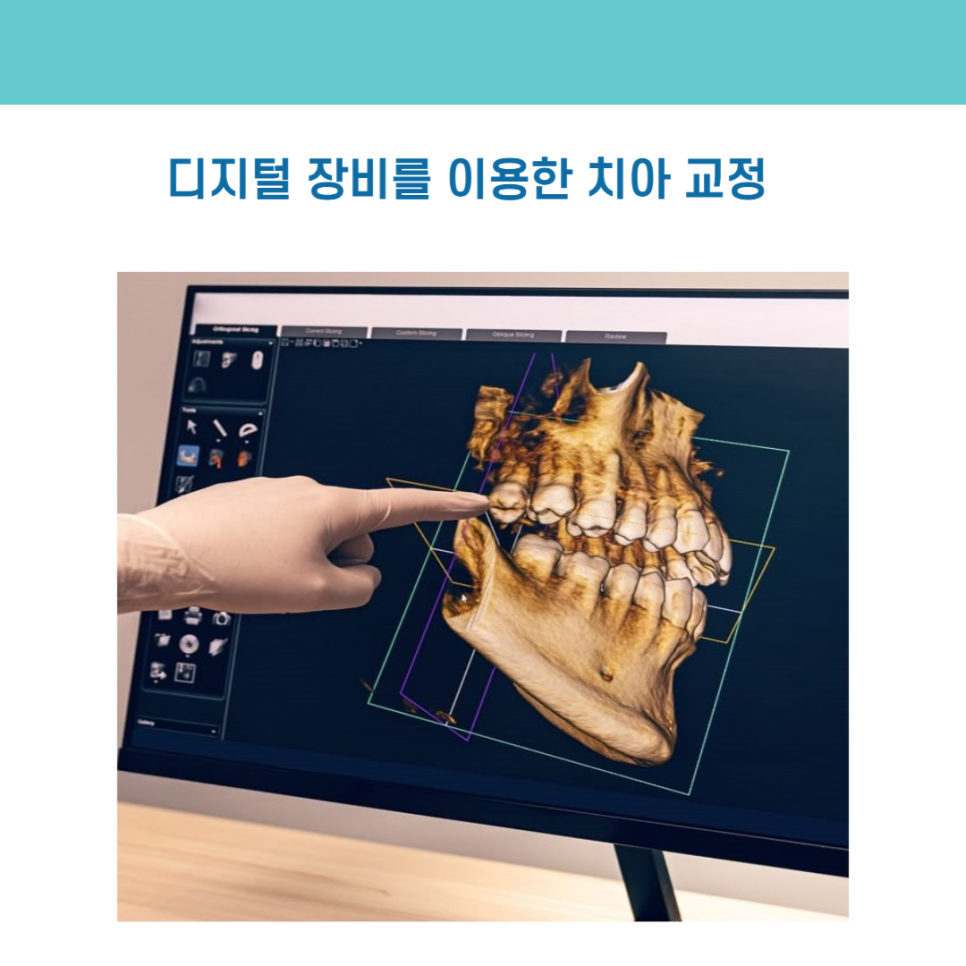 디지털 장비를 이용한 맞춤 치아 교정 관련 이미지 3