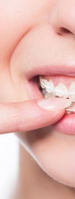 디지털 장비를 이용한 맞춤 치아 교정 관련 이미지 10