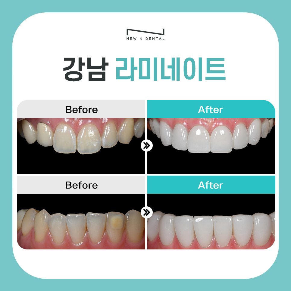 강남라미네이트 잘하는 곳 뉴엔치과 관련 이미지 2