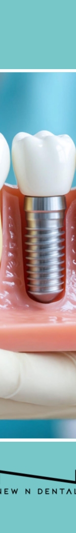 강남역치과 임플란트 뼈이식, 흡연과 음주가 미치는 영향은? 관련 이미지 12