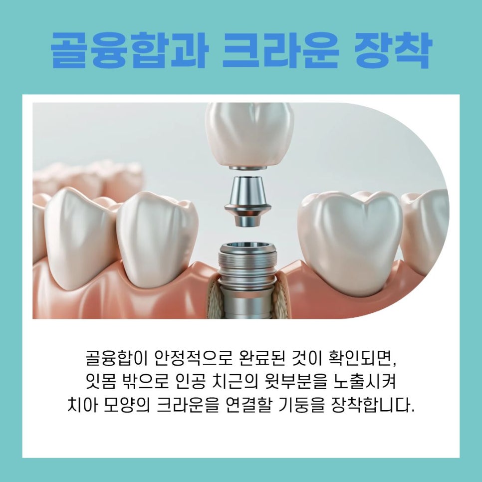 Understanding the Treatment Process at a Gangnam Station Implant Dental Clinic image 7
