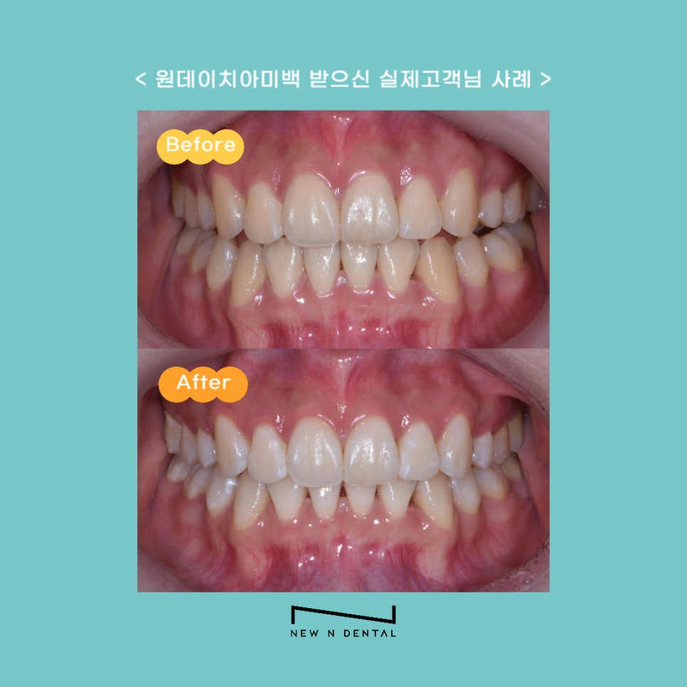 원데이 치아미백 변색의 원인과 후유증 없는 찐후기 관련 이미지 10