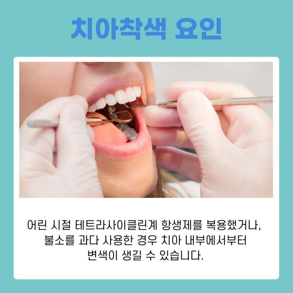 강남역 치아미백 누런니 고민해결 밝은 미소 되찾는 법 관련 이미지 4