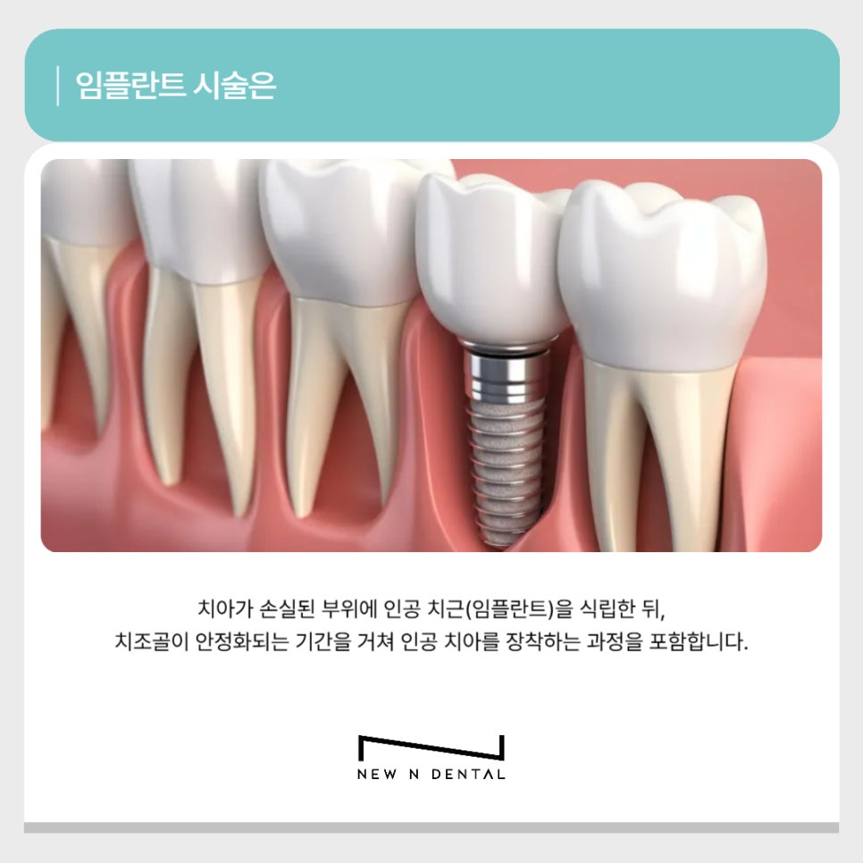 강남 당일임플란트 가능한 곳 뉴엔치과에서 관련 이미지 2