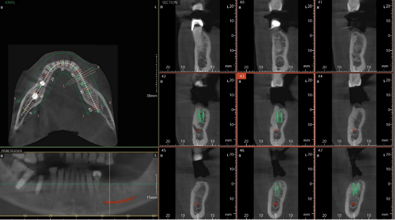 역삼동임플란트 컴퓨터로 상세하게 치료 관련 이미지 7