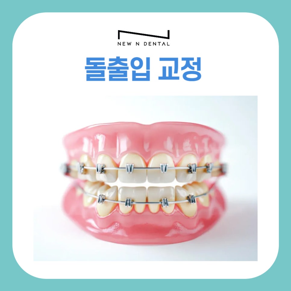 돌출입 교정 치과 비용, 치료 전 꼭 알아야 할 점 관련 이미지 2