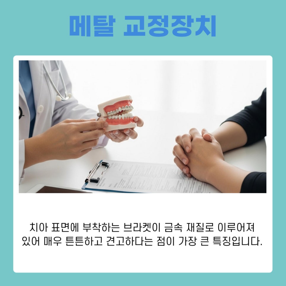 A Guide to Choosing the Right Orthodontic Appliance for You from a Yeoksam-dong Orthodontic Clinic image 6