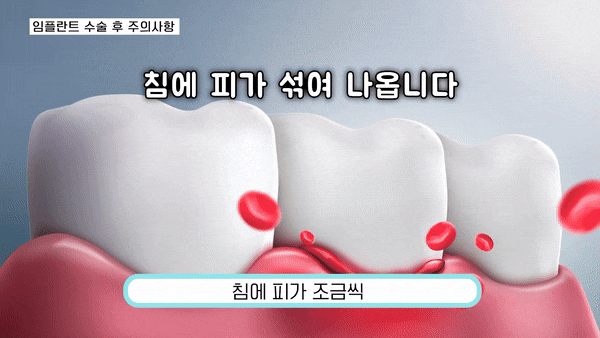 강남역임플란트수술 달라지는 일상의 즐거움 관련 이미지 3