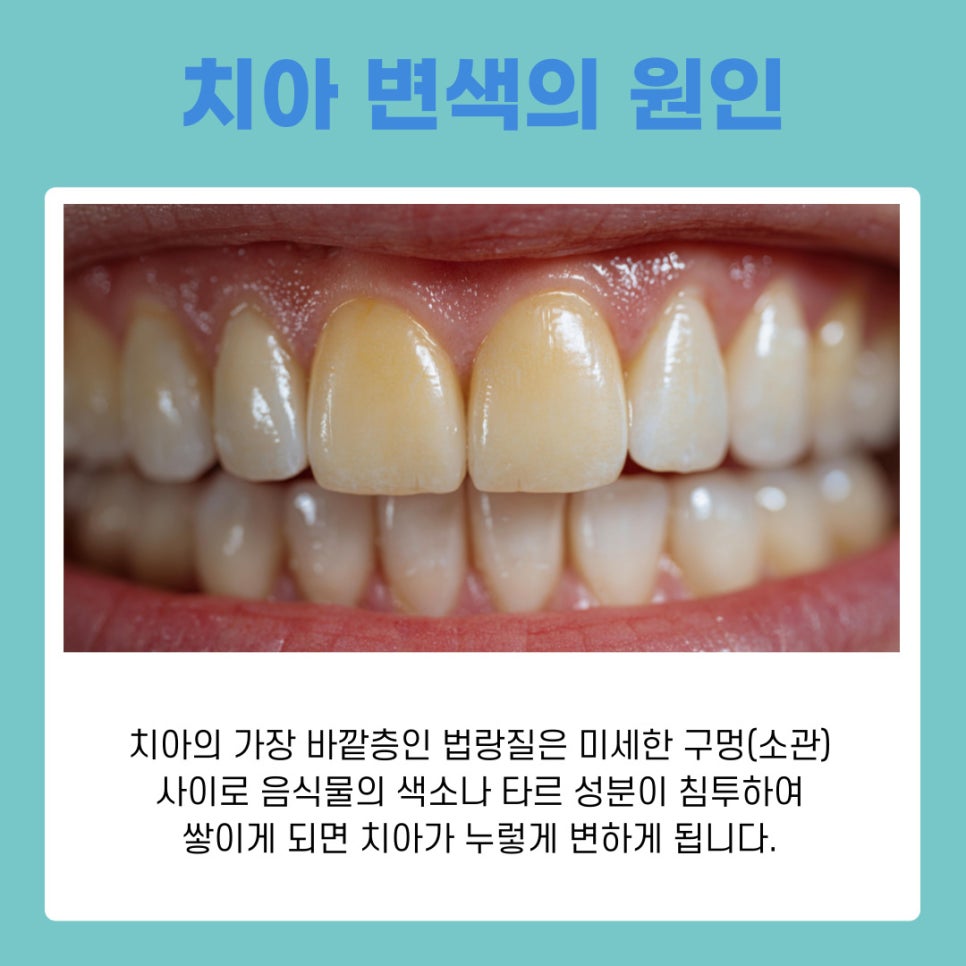 치과 치아미백의 원리부터 종류별 특징까지 완벽 가이드 관련 이미지 3