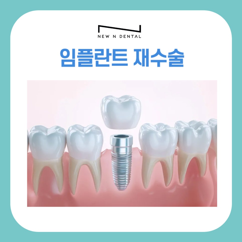 강남 임플란트 재수술, 어떤 경우에 필요할까 관련 이미지 2