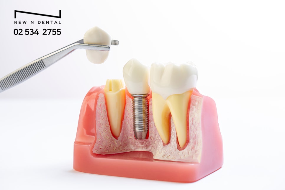 네비게이션임플란트 세계적으로 인정된 방법 관련 이미지 6