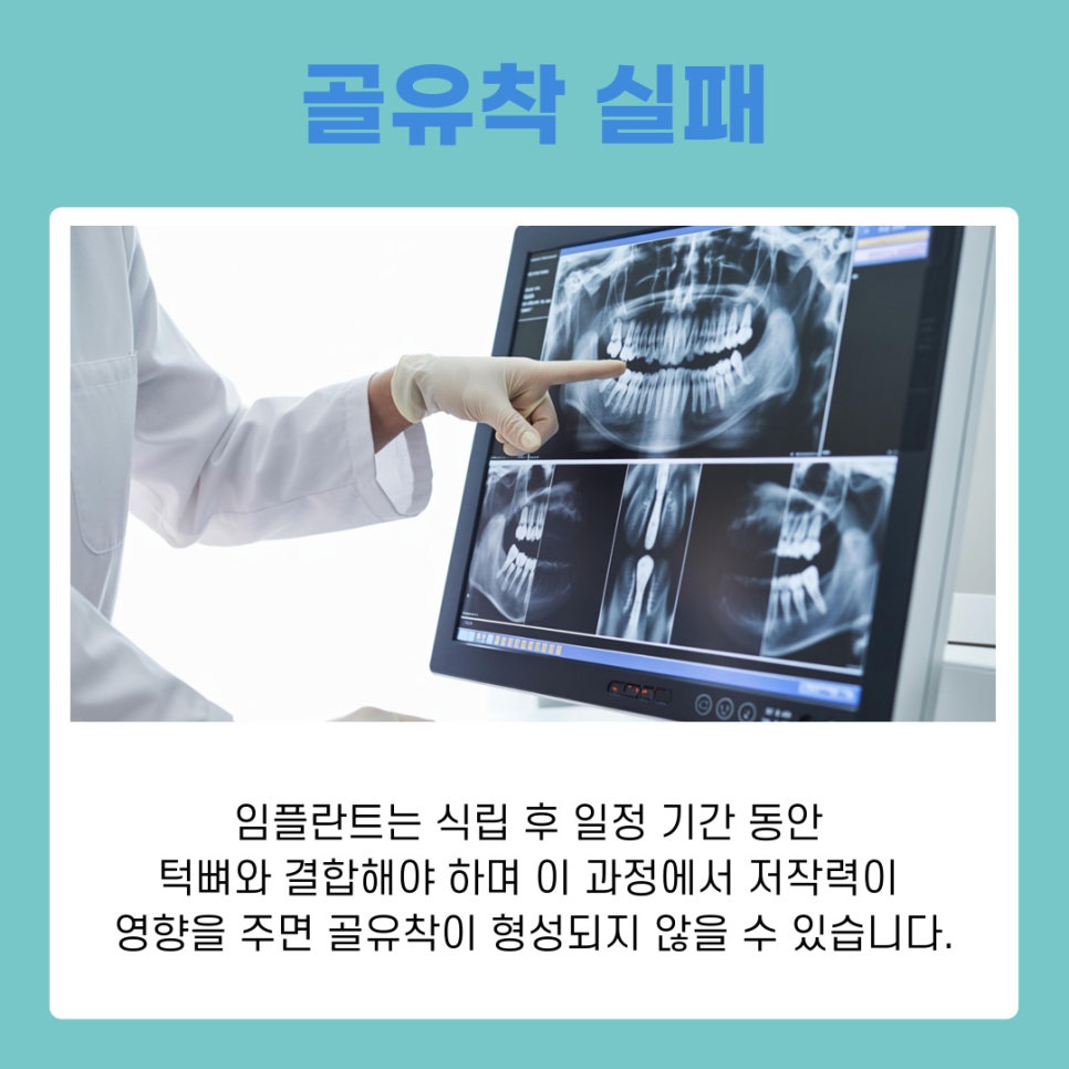 강남논현동치과 임플란트 빠짐 원인과 재치료 가능성 정리 관련 이미지 5