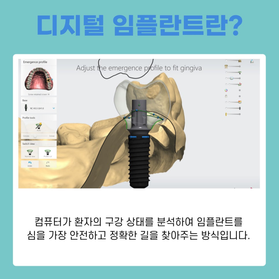 강남 디지털임플란트치과 시술 과정 총정리 관련 이미지 6