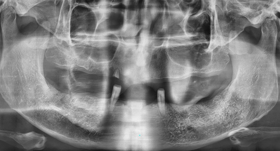 논현동임플란트잘하는곳 컴퓨터 분석으로 보다 면밀하게 관련 이미지 5