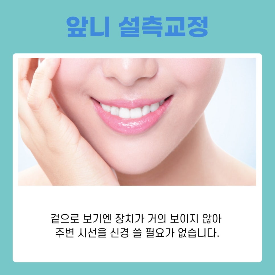 Orthodontics Near Gangnam Station: Differences Between Anterior Lingual Braces and Clear Aligners by Type image 4