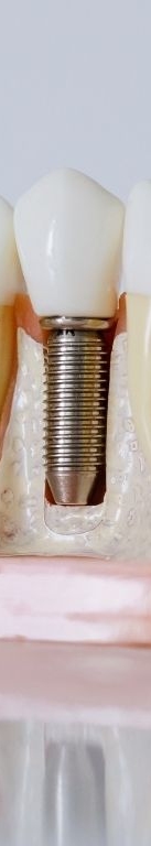 강남 전체임플란트 틀니 생각하고 있다면 관련 이미지 14