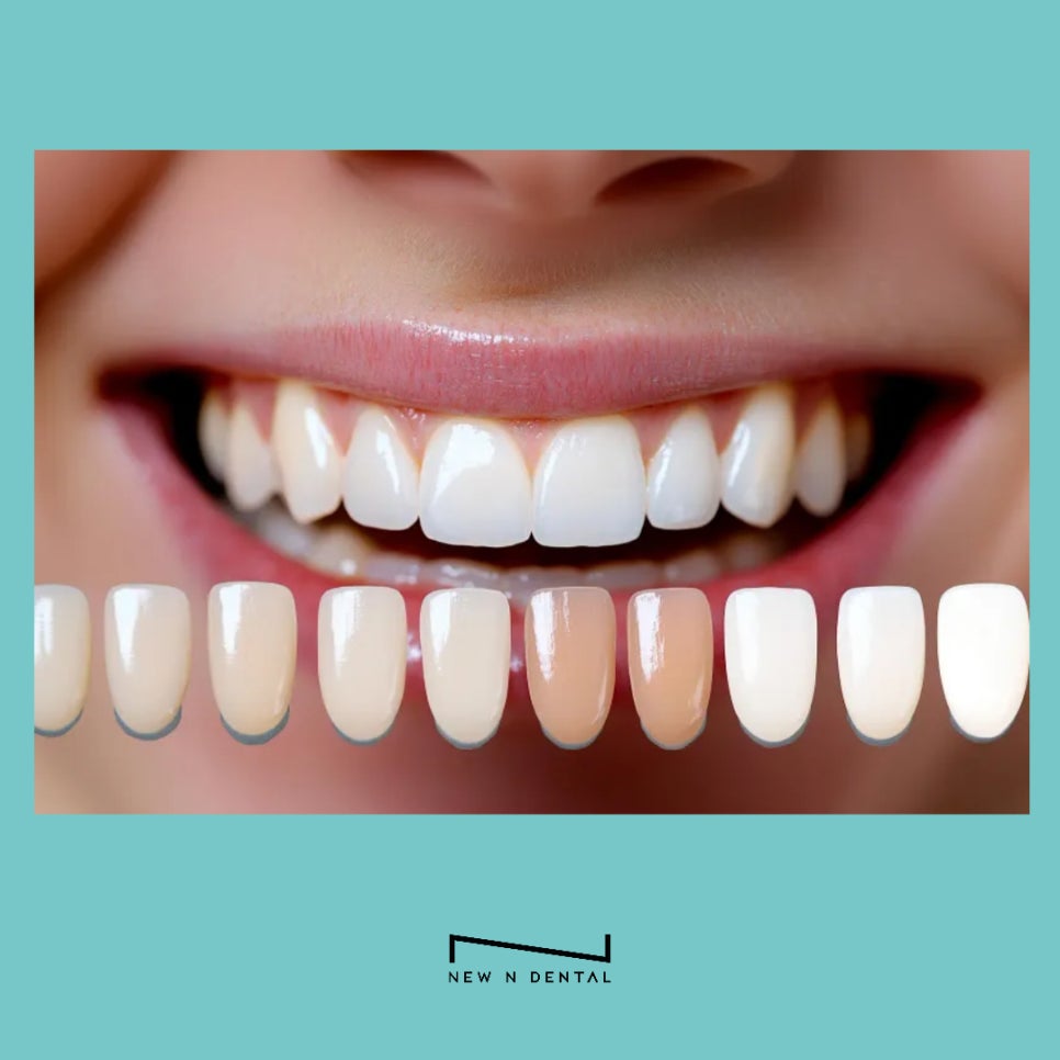 강남치과 원데이치아미백 누런치아 탈출 관련 이미지 14