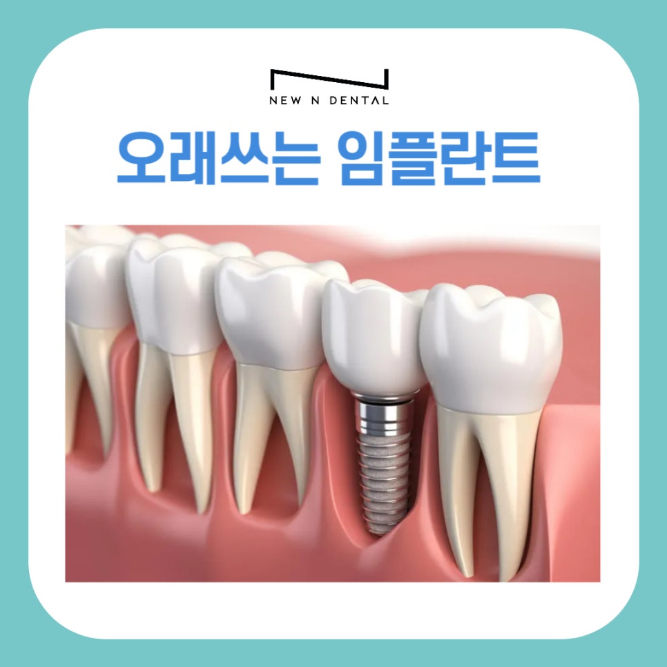 강남역임플란트 오래쓰는 뉴엔치과의 전문성 관련 이미지 1