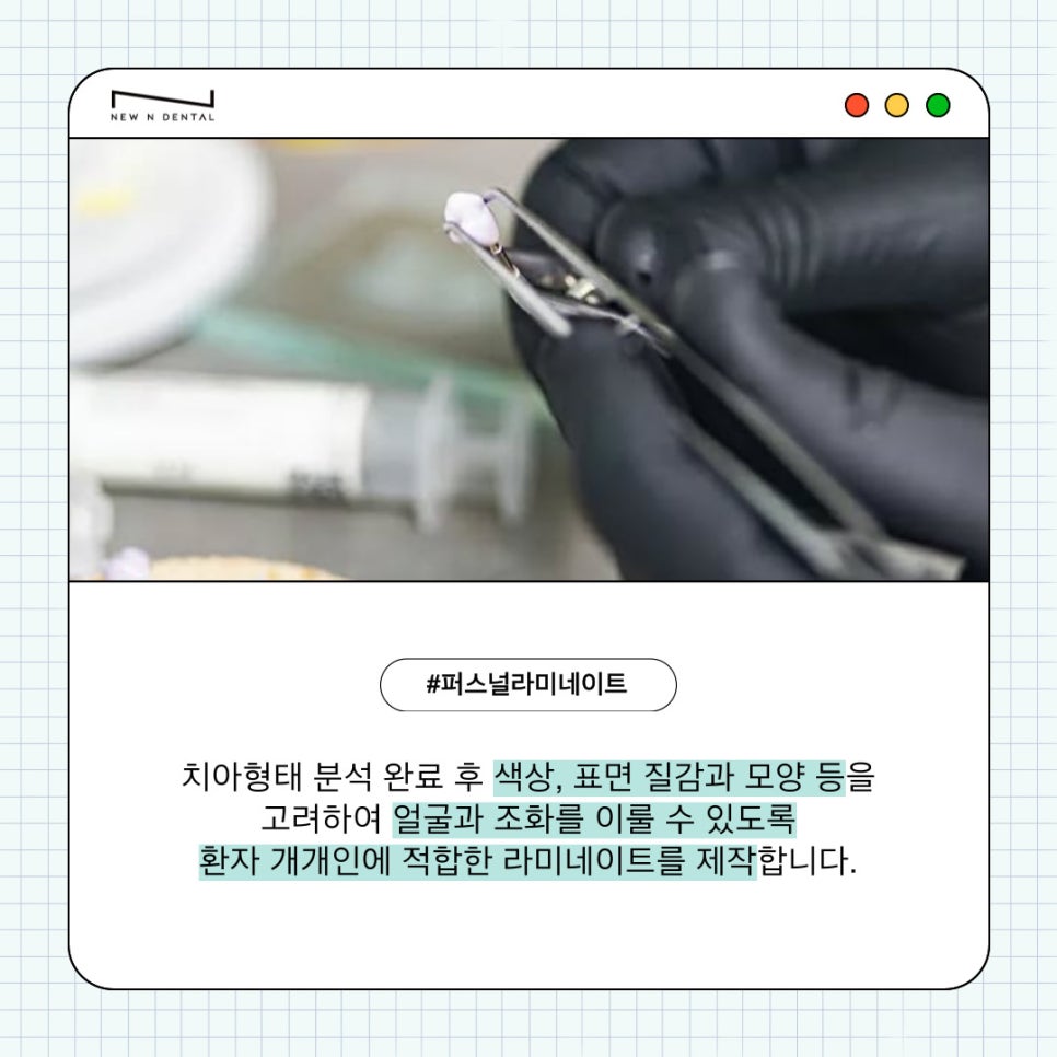자연치아를 최대한 보호하는 최소삭제라미네이트 관련 이미지 6