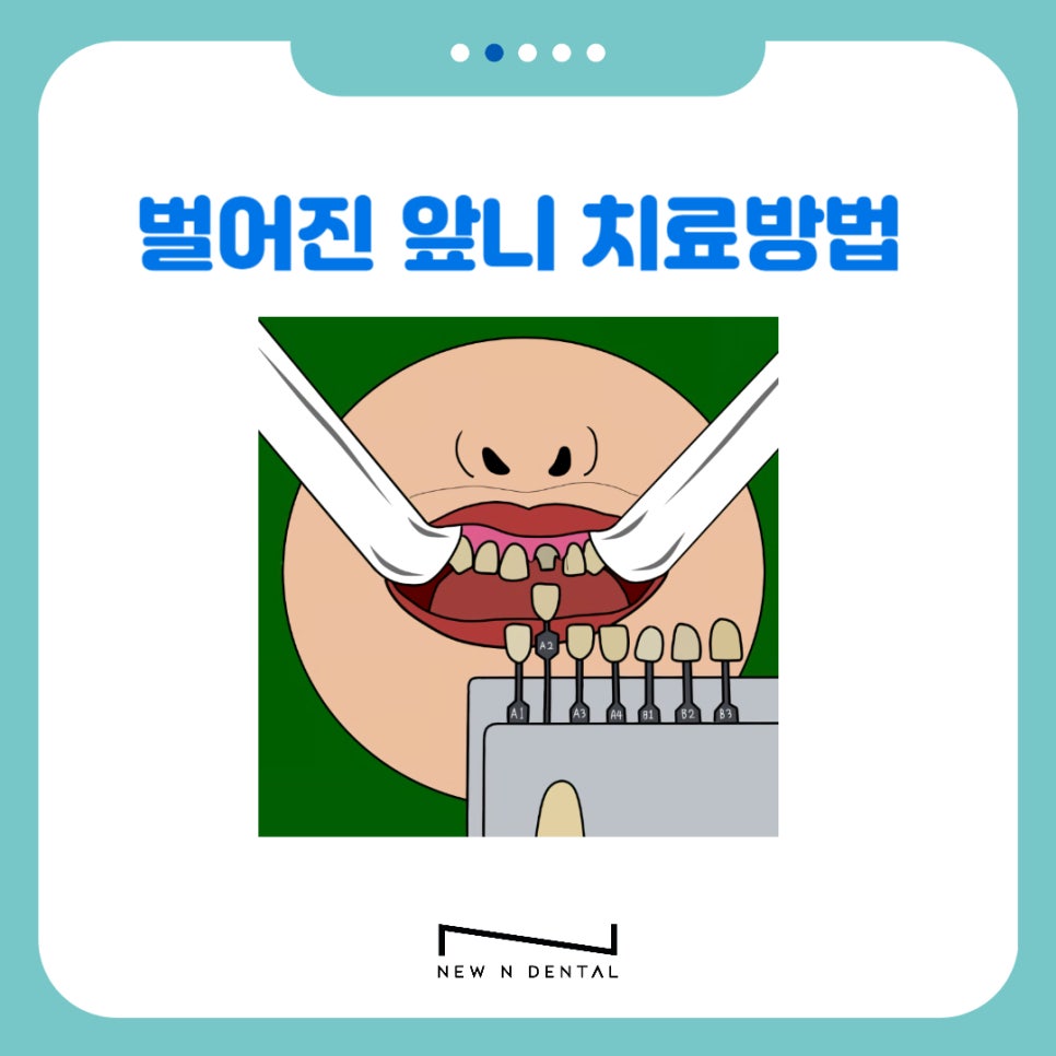 강남역치과 앞니 벌어짐 원인, 치료와 방법 관련 이미지 14