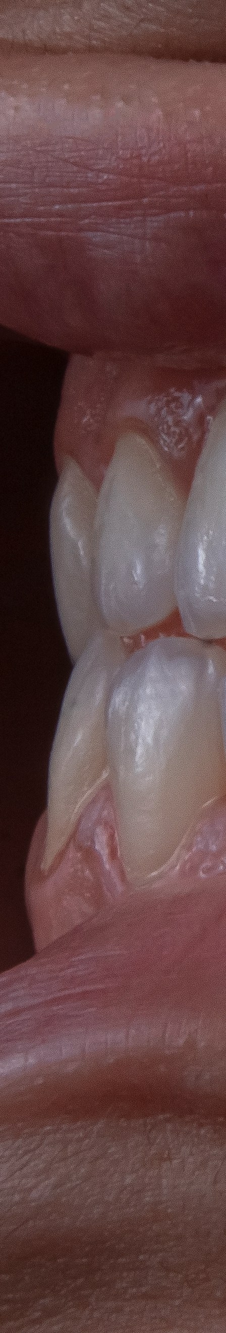 치아 미백 효과와 부작용 체크해야 할 사항 관련 이미지 21