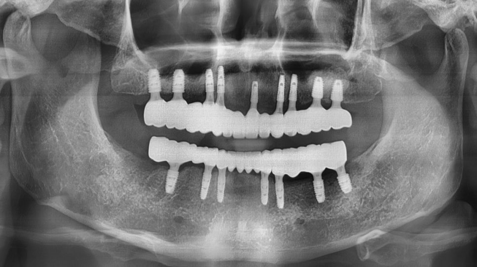 서초동임플란트치과 자연 치아가 탈락했다면 관련 이미지 9