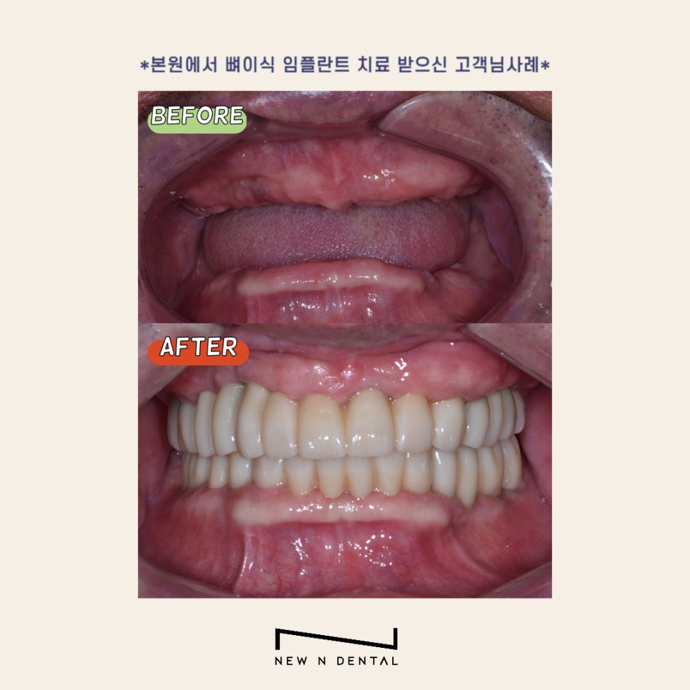 강남역 임플란트 뼈이식 잘하는 곳 뉴엔치과 관련 이미지 11